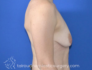 Breast Lift
