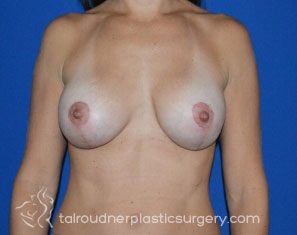 Breast Revision