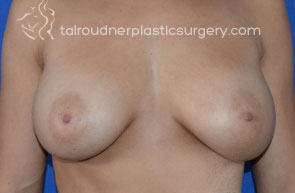 Breast Revision