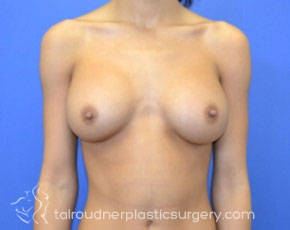 Breast Revision