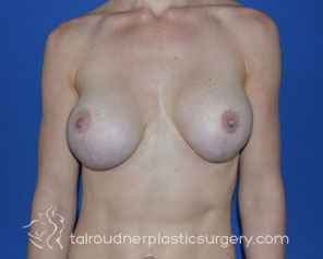 Breast Revision