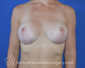 Breast Revision