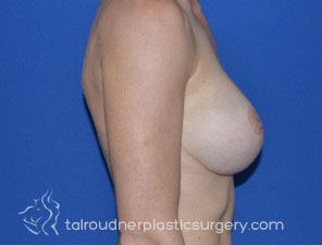 Breast Revision