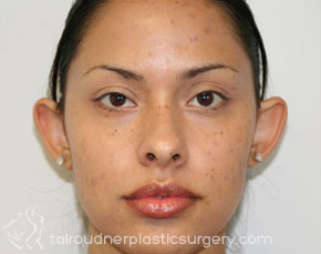 Ear Surgery (Otoplasty)
