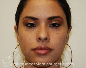 Ear Surgery (Otoplasty)