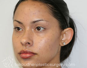 Ear Surgery (Otoplasty)