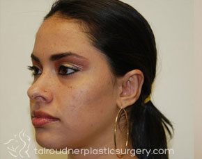 Ear Surgery (Otoplasty)