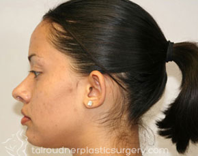 Ear Surgery (Otoplasty)