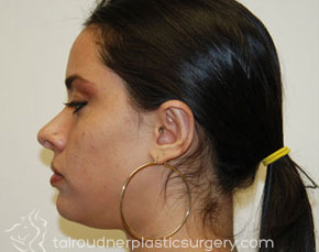 Ear Surgery (Otoplasty)