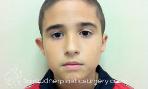 Ear Surgery (Otoplasty)