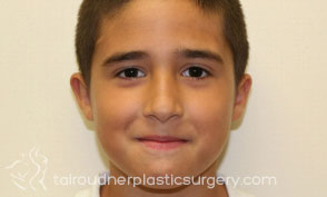 Ear Surgery (Otoplasty)