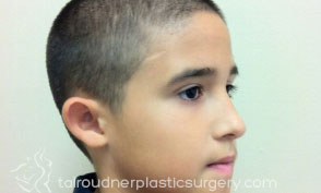 Ear Surgery (Otoplasty)