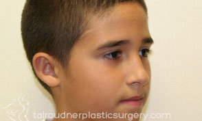 Ear Surgery (Otoplasty)