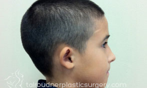 Ear Surgery (Otoplasty)