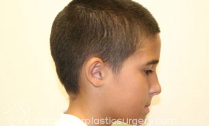 Ear Surgery (Otoplasty)