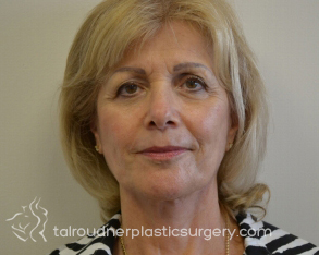 Facelift