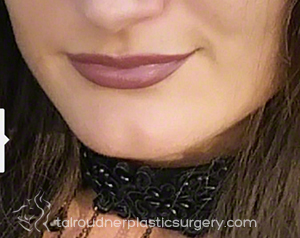 Lip Augmentation