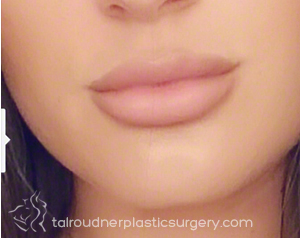 Lip Augmentation