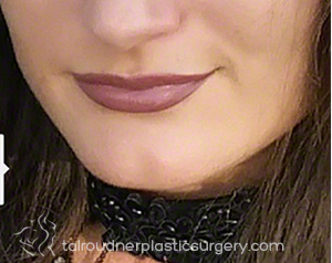 Lip Augmentation