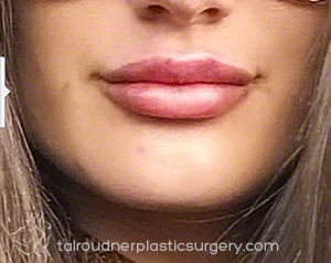 Lip Augmentation