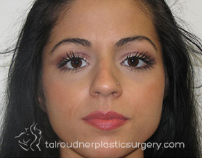 Nose Surgery (Rhinoplasty)