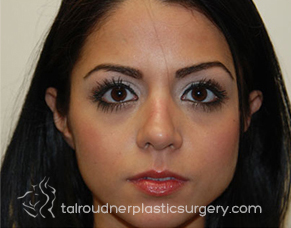 Nose Surgery (Rhinoplasty)