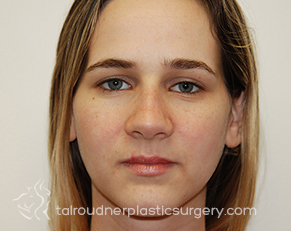 Nose Surgery (Rhinoplasty)