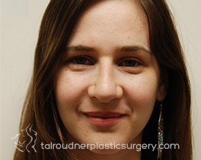 Nose Surgery (Rhinoplasty)