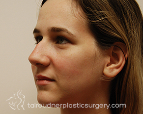 Nose Surgery (Rhinoplasty)