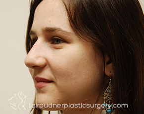 Nose Surgery (Rhinoplasty)