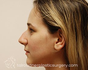 Nose Surgery (Rhinoplasty)