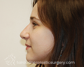 Nose Surgery (Rhinoplasty)