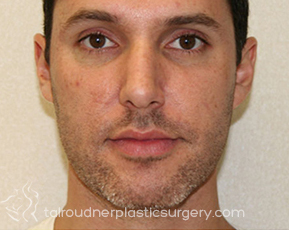 Nose Surgery (Rhinoplasty)