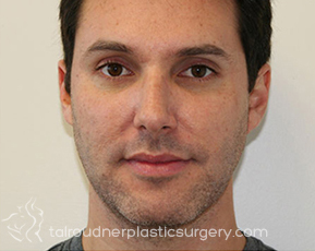 Nose Surgery (Rhinoplasty)