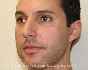 Nose Surgery (Rhinoplasty)