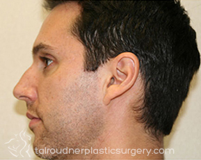 Nose Surgery (Rhinoplasty)