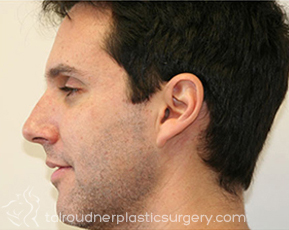 Nose Surgery (Rhinoplasty)