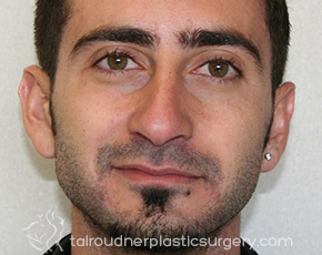 Nose Surgery (Rhinoplasty)