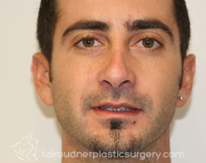 Nose Surgery (Rhinoplasty)