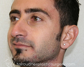 Nose Surgery (Rhinoplasty)