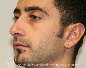 Nose Surgery (Rhinoplasty)