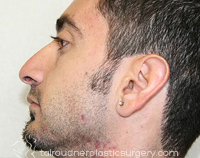Nose Surgery (Rhinoplasty)