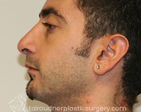 Nose Surgery (Rhinoplasty)