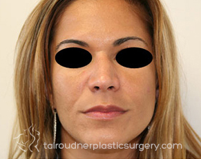 Nose Surgery (Rhinoplasty)