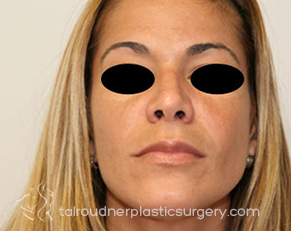 Nose Surgery (Rhinoplasty)