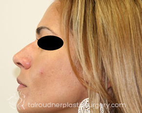 Nose Surgery (Rhinoplasty)