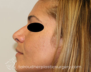 Nose Surgery (Rhinoplasty)