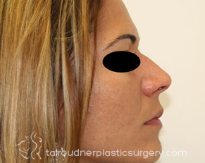 Nose Surgery (Rhinoplasty)