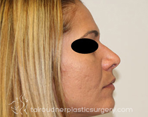 Nose Surgery (Rhinoplasty)
