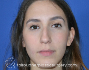 Nose Surgery (Rhinoplasty)